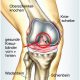 Knie Operationen Arthrose Arthroskopie