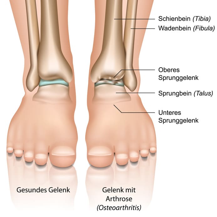 Vergleich eines gesunden Fußes mit einem an Arthrose erkrankten Fußes